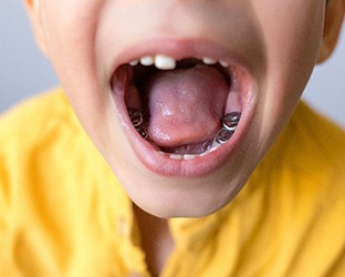 Up-close view of patient with stainless steel crowns