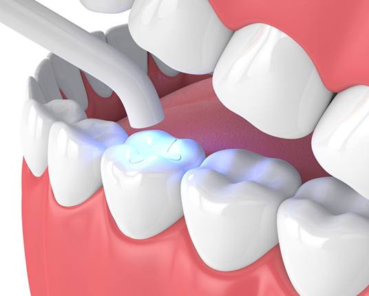 Illustration of curing light being used to harden a tooth-colored filling