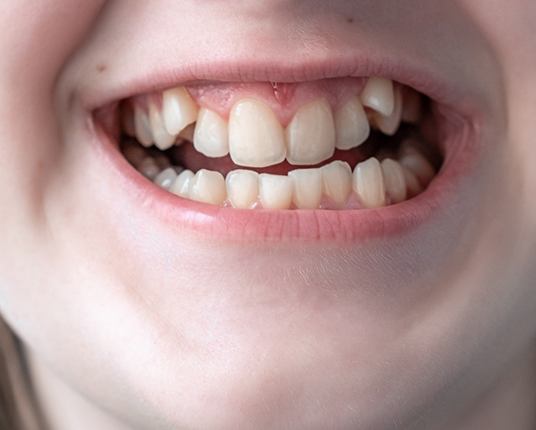 Child’s crooked teeth