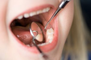 Close up of child’s mouth at dentist